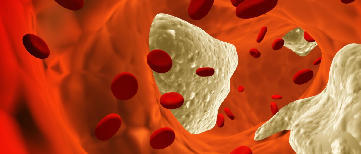 Ateroskleroza- bolest krvnih sudova